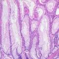 Colon_histology_with_Peutz-Jeghers_polyp